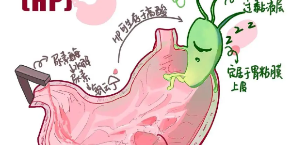 【必看】幽門螺桿菌真相揭示，別再忽視你的胃痛了！